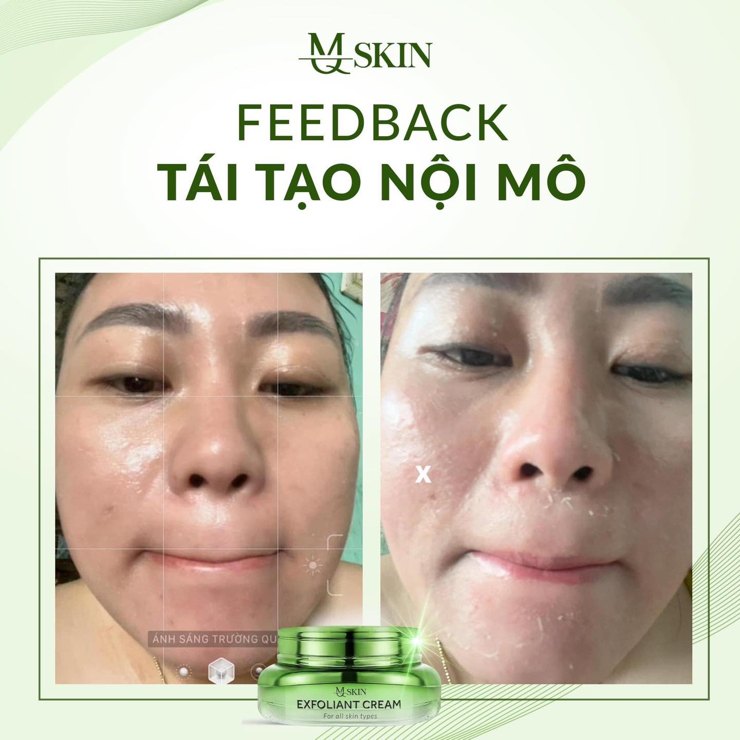 Kem Face Tái Tạo Nội Sinh Exfoliant Cream MQ Skin Tặng Kem Dưỡng HA