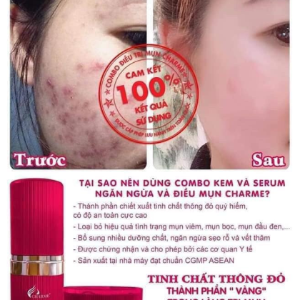 Kem Face Mụn Hàn Quốc Charme Anti Acne Whitening Cream