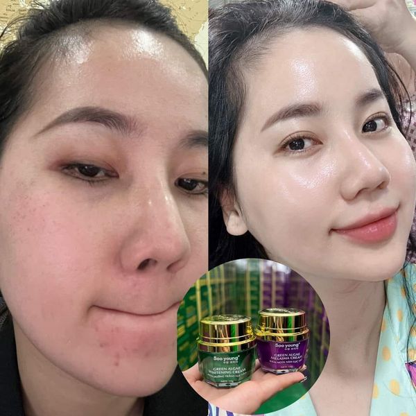 Kem Face Tím Giảm Nám Soo Young Mini Green Algae Melasma Cream hỗ trợ  cấp ẩm chống nắng