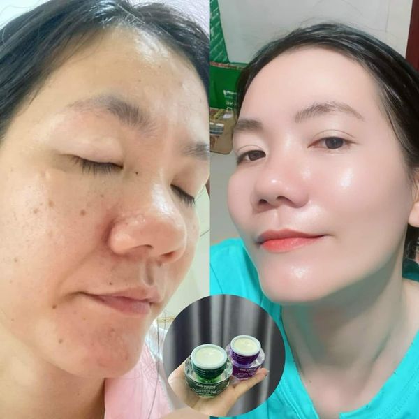 Kem Face Tím mini hỗ trợ Giảm Nám Soo Young Mini Green Algae Melasma Cream 10g Phá vỡ rào cản  Xóa mờ sạm nám