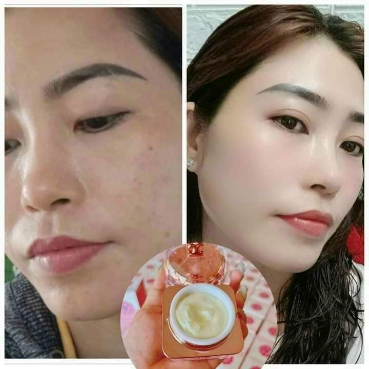 Đẹp Không Tì Vết Với Kem Face Peel Da NICOS