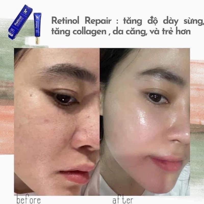 Giờ mà chưa biết  Retinol K Lady thì đúng là hối tiếc suốt đời luôn á