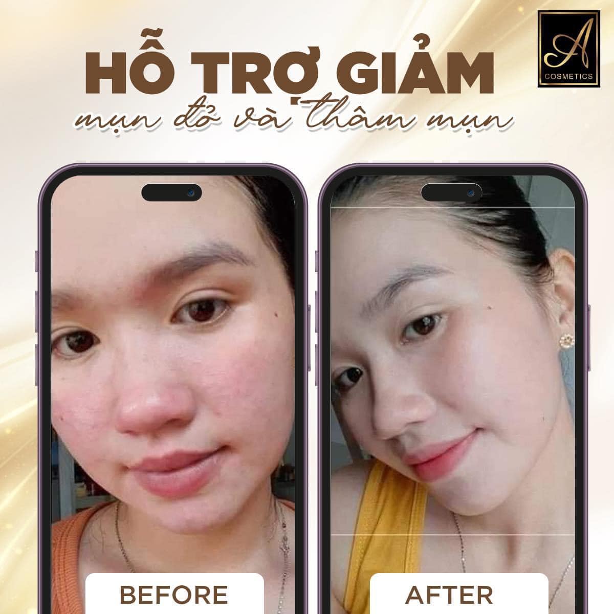 Combo Giảm Mụn Beauty One Day A Cosmetics Mỹ Phẩm Phương Anh